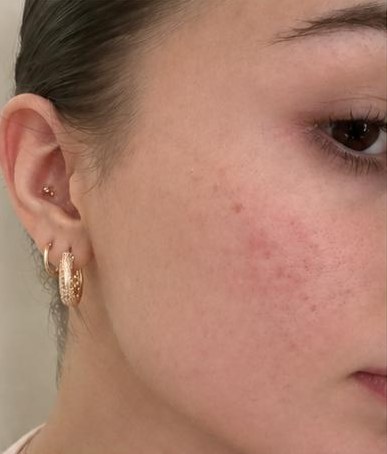 Dieselbe Wange mit ruhigerem, ebenmässigerem Hautbild nach der Behandlung