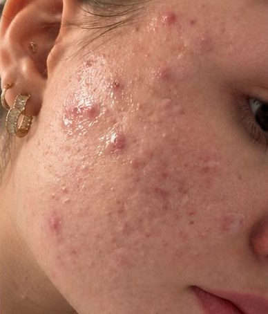 Wange mit unreiner Haut vor der Aquafacial-Behandlung