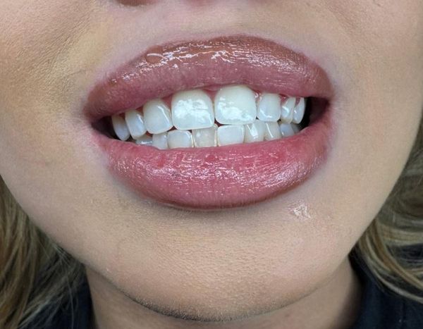 Sichtbar hellere Zähne nach dem Zahnbleaching